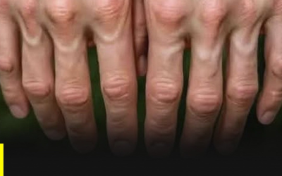 Por que suas veias parecem mais proeminentes: sinais do corpo que você deve entender.