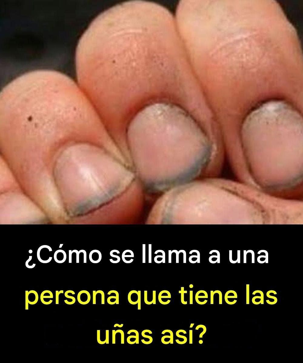 ¿Cómo se llama a una persona que tiene las uñas así?