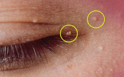 ¿Cómo eliminar los milium: esos molestos quistes de grasa?